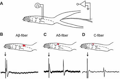 Accumulation of Cav3.2 T-type Calcium Channels in the Uninjured Sural Nerve Contributes to Neuropathic Pain in Rats with Spared Nerve Injury